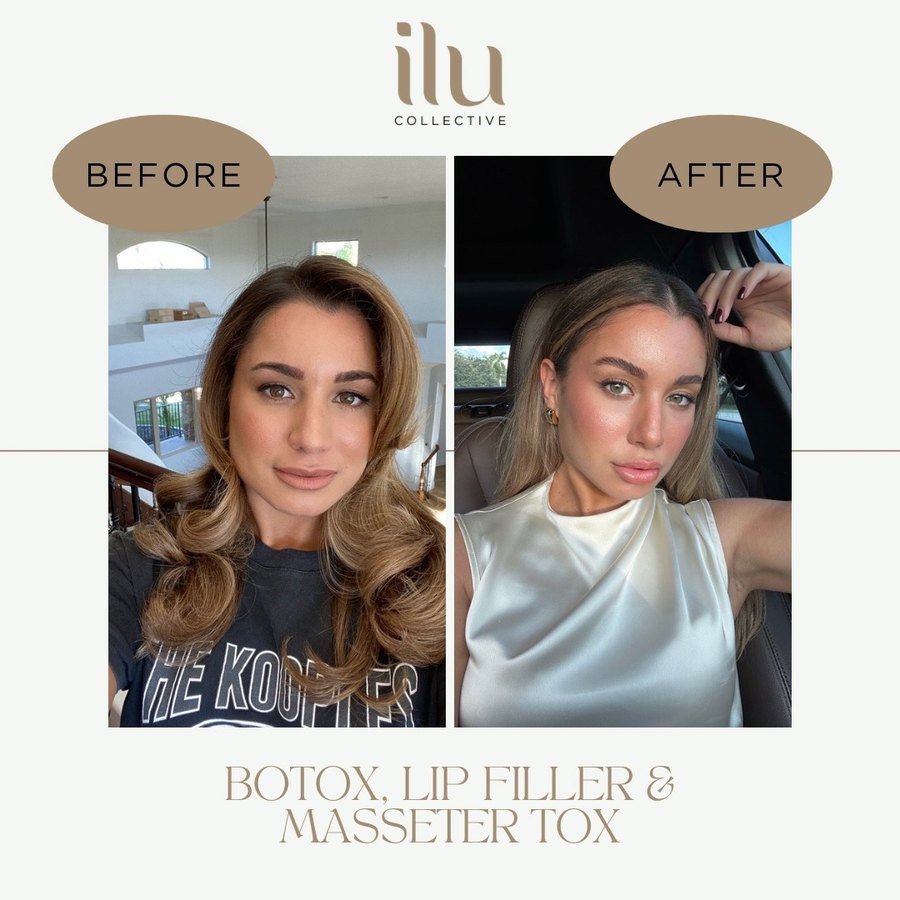 ILU Collective Facial Rebalancing — real before and after results